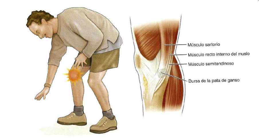 Dolor en la parte anterior de la rodilla - Traumatismos y