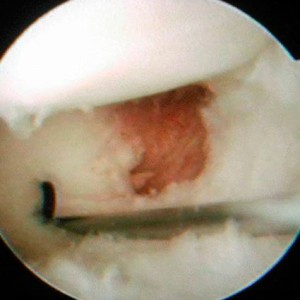 Rotura fibrocartílago