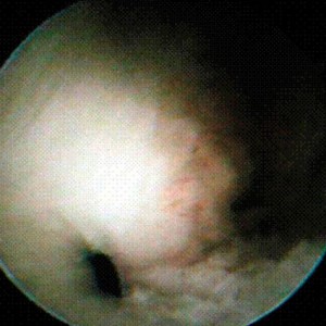 Rotura fibrocartílago