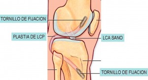 Tornillos de fijación