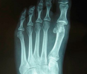 Cirugía del pie