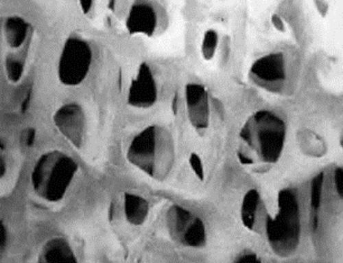 OSTEOPOROSIS Y ARTROSIS