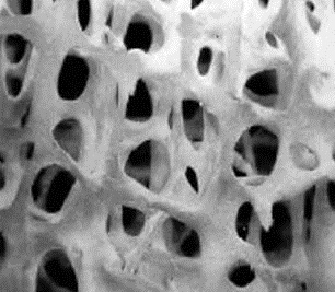 Osteoporosis y artrosis